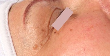 Résultat après 3 séances de JetPeel